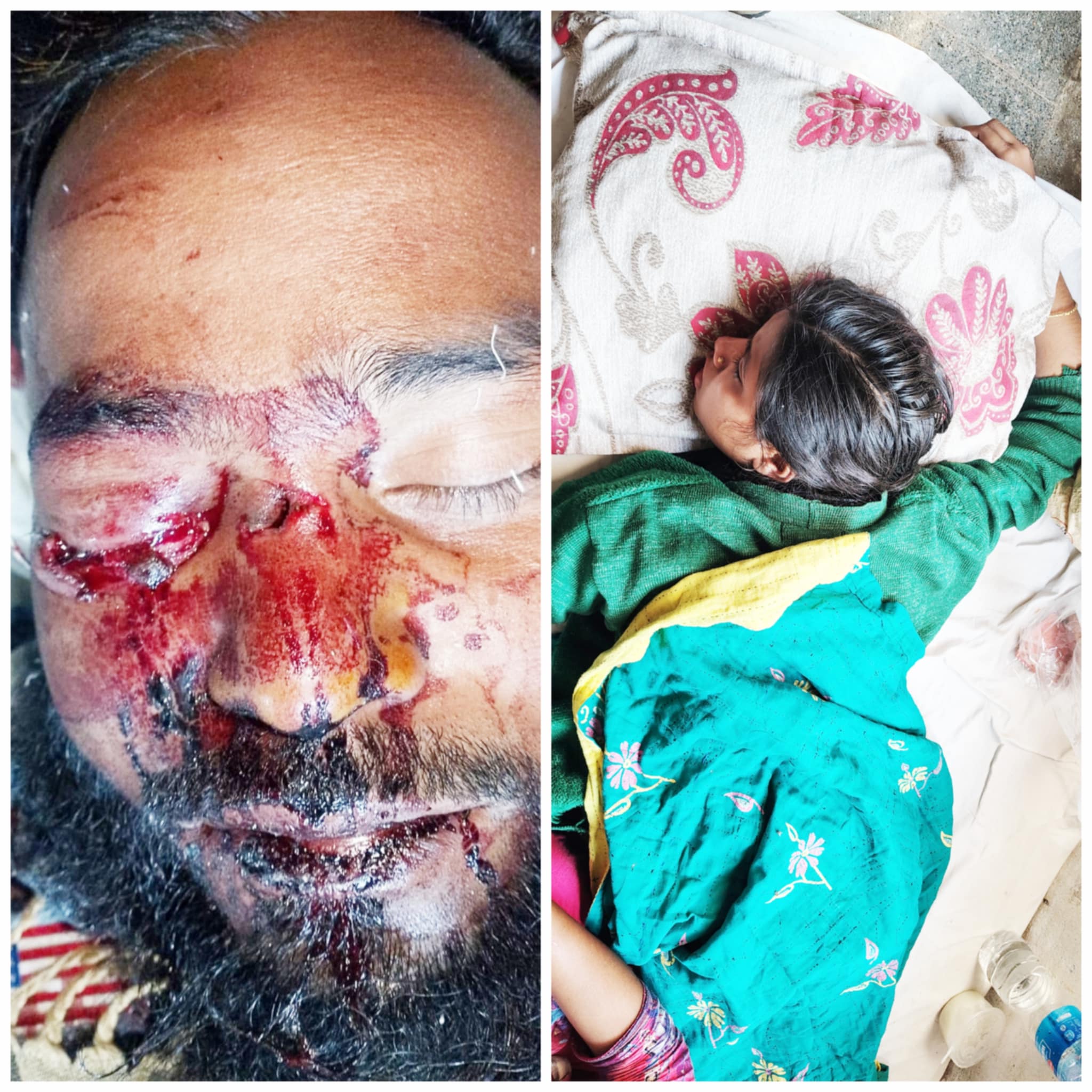 বাকেরগঞ্জে যৌতুকের দাবিতে নির্যাতন আহত ৩, মামলা দায়ের,